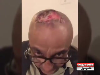 اداکار ساجد حسن کے سر میں ہیئر ٹرانسپلانٹ سے گہرا زخم ہوگیا